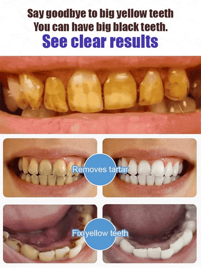 🔥$19.99 ONLY TODAY!!🎁Clearance Sale - Non Fluoride, Hydroxyapatite, Whitening Toothpaste